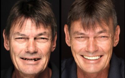 Livet før og etter nye tenner